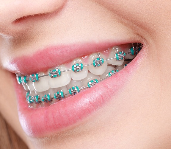 Closeup of beautiful smile with traditional braces in South Elgin, IL