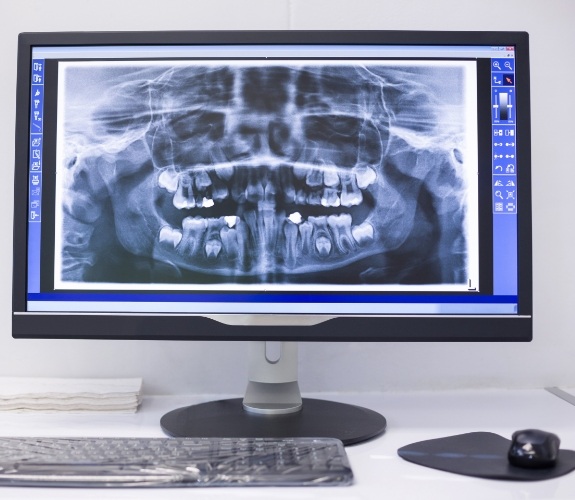 Computer screen showing digital x rays of teeth