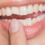 Close up of person pointing to their chipped tooth