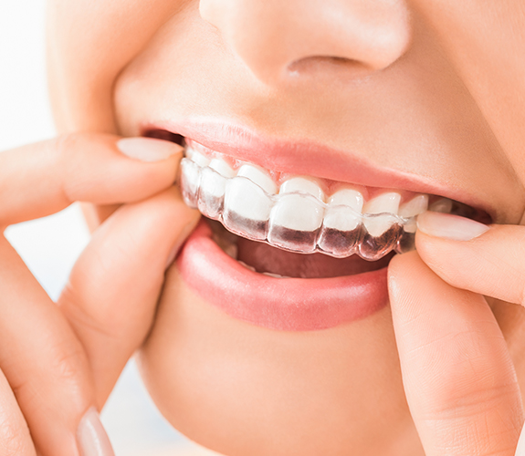 Woman placing Clear Aligners tray