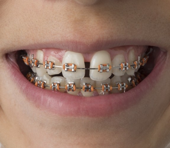 Close up of a child smiling with traditional braces in South Elgin