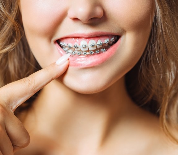Woman with metal braces pointing to her smile