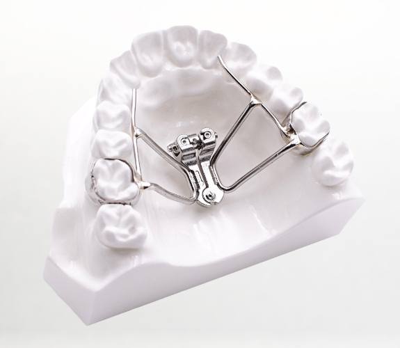 Metal wire expander on palate of model of the mouth