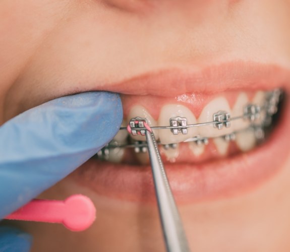 Orthodontist placing elastic bands on a patients braces
