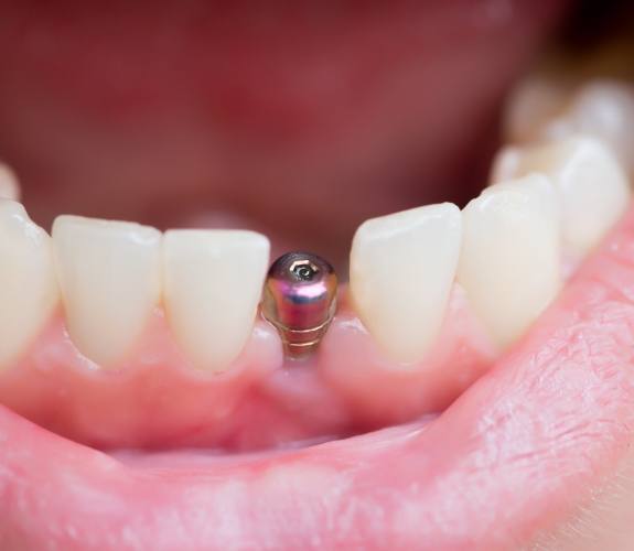 Close up of a smile with a dental implant replacing a missing lower tooth