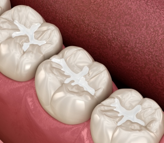 Illustrated teeth with white fillings