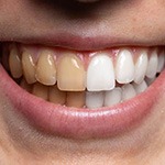 Up-close before and after teeth whitening